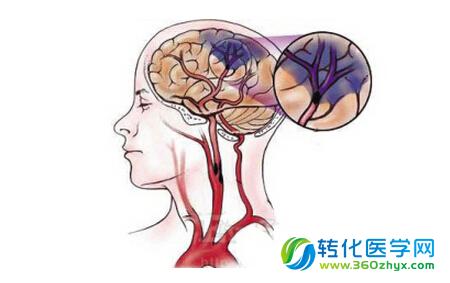 中国医学专家：补叶酸可降低高血压人群