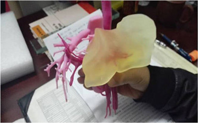 全国首例借助3D打印实现母子拼肝移植手术在沪成功完成