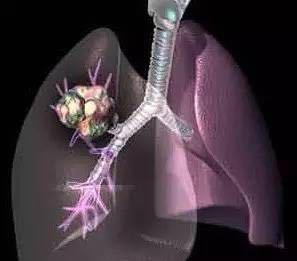 科学家在抑制肺癌扩散方面又进一步