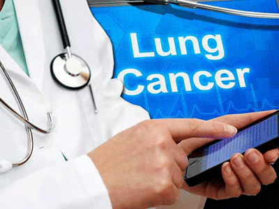 新应用可快速分析肺癌风险