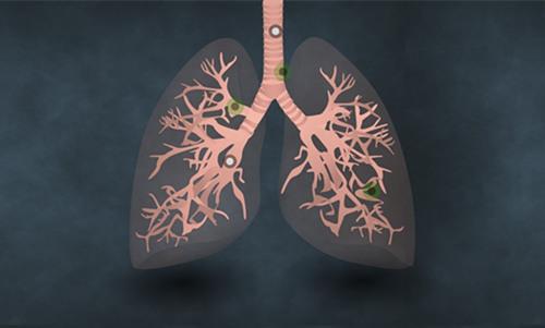 最新！复旦大学高文团队发现非小细胞肺癌潜在治疗靶点
