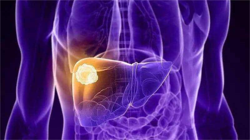 最新！香港大学研究学者发现肝细胞癌潜在治疗靶点