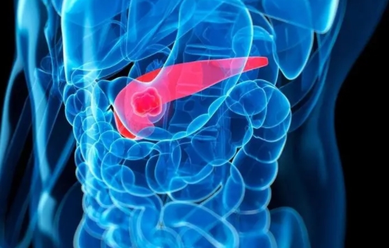 “候选靶点”！剑桥大学发文：揭示胰腺癌转移新机制