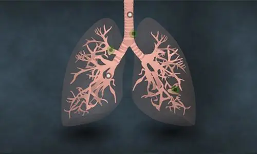 再取进展！同济大学研究学者发现非小细胞肺癌最新预测标志物