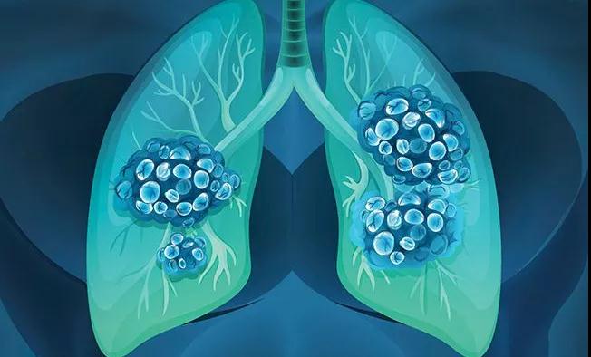 新靶点！福建医科大学：开辟非小细胞肺癌治疗新途径