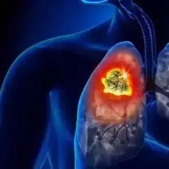 肺癌患者采用靶向治疗还是免疫治疗好?