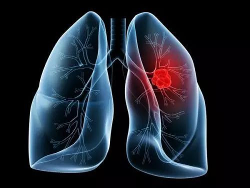 肿瘤常见生物标志物之：肺癌