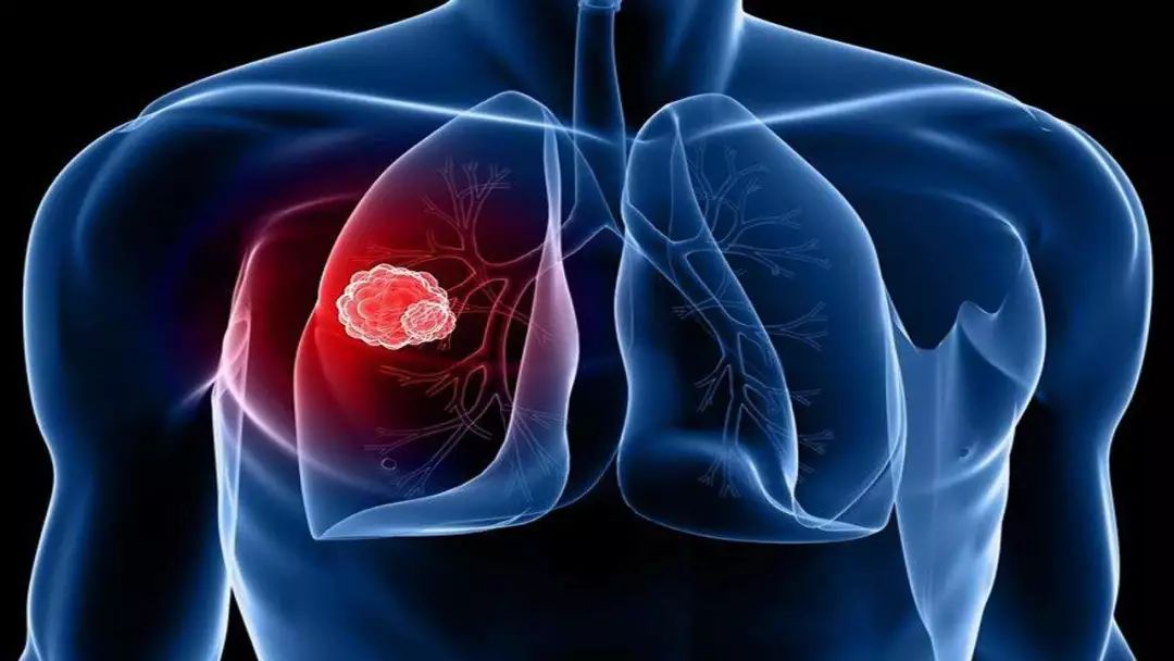 肺癌治疗进入3.0时代：奥希替尼正式获批中国EGFR突变晚期非小细胞肺癌的一线治疗