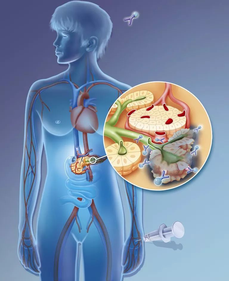 Cell Reports：新的胰腺癌联合治疗方案可逆转肿瘤微环境！