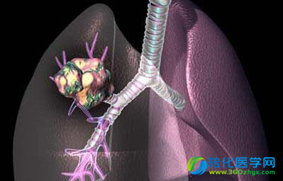 肺癌可在人体内潜伏20余年