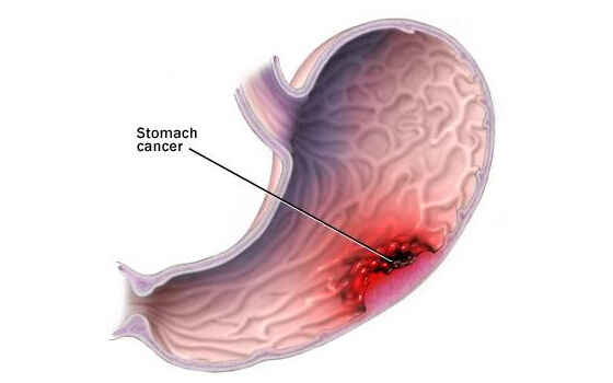 PNAS：脂质纳米颗粒或可有效治疗细菌性胃溃疡及胃癌
