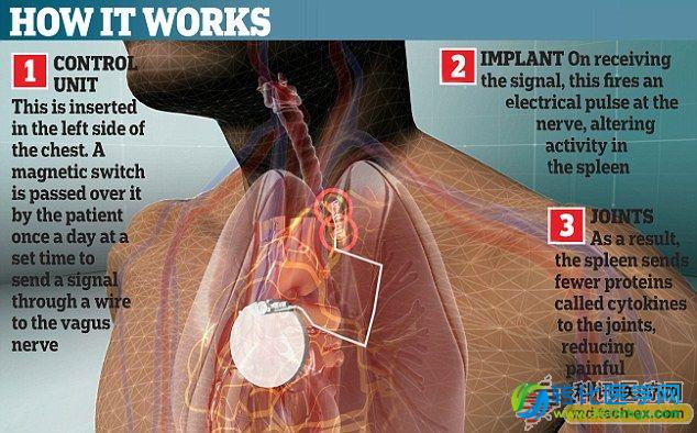 植入设备通过规避神经可解除关节炎患者痛苦