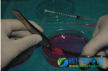 突破！植入保存十年的卵巢组织 终诞下健康婴儿