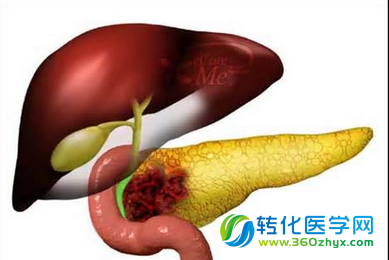 特殊microRNA或可帮助开发治疗胰腺癌的新型手段