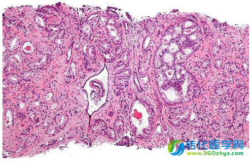 科学家首次将前列腺癌分为5种不同的类型