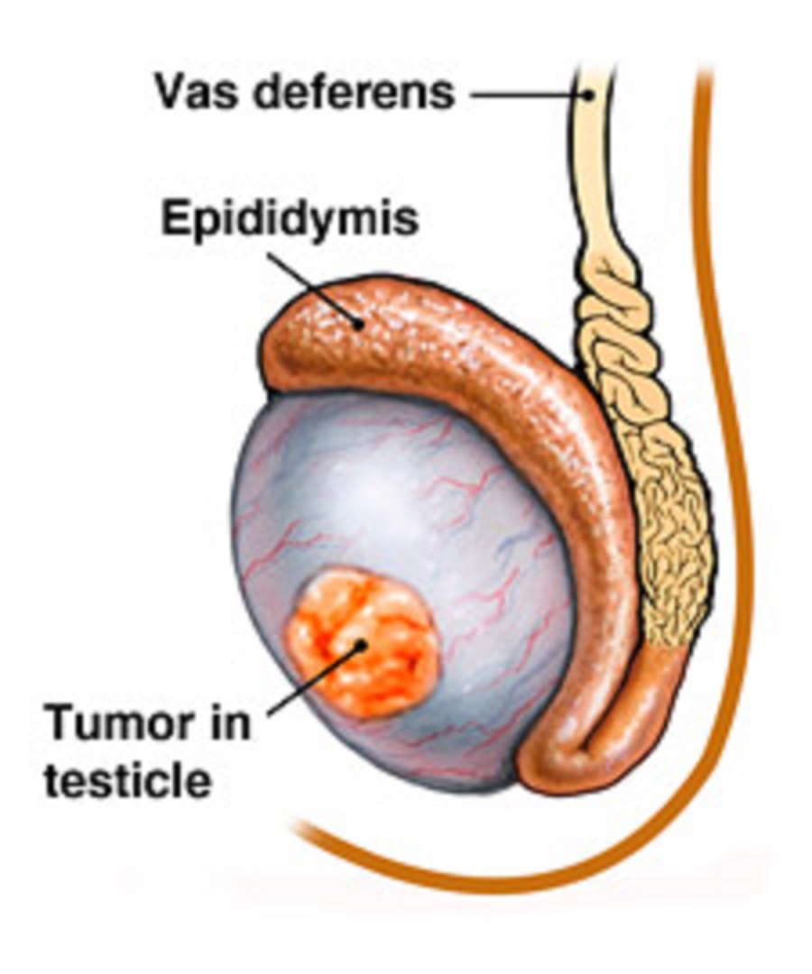 睾丸癌晚期图片