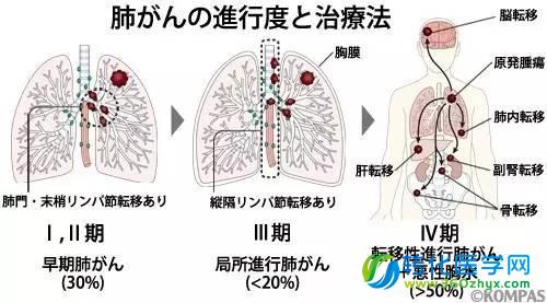 肺癌的症状和治疗法：肺癌真的是抽烟导致的吗？