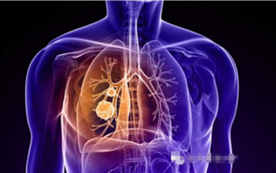 Global Cancer Diagnostics公司启动了肺癌检测试验的确认研究