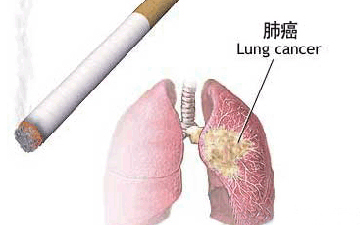 中国 EGFR 基因敏感突变和 ALK 融合基因阳性 NSCLC 诊疗指南