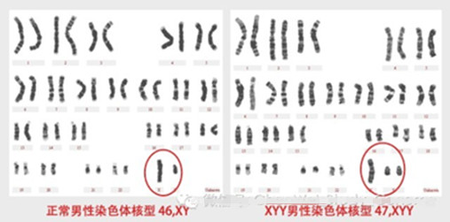 盘点：那些多了或少了一个条性染色体的女人和男人