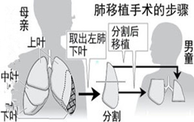 日本成功实施全球最精细活体肺移植手术