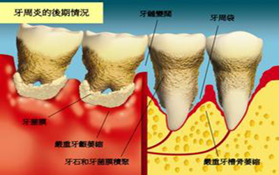 牙周炎或与认知障碍相关