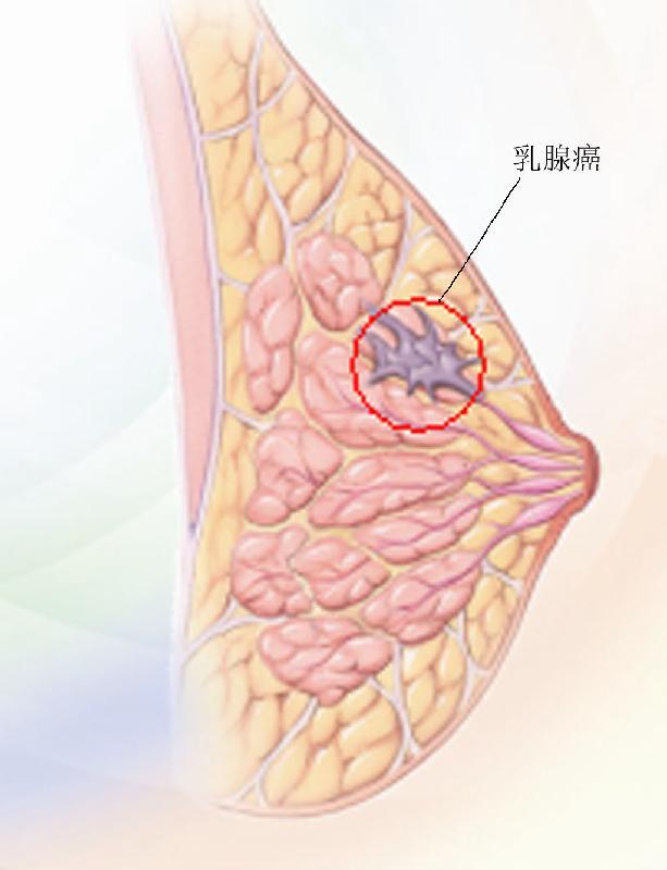 科学家揭示引发罕见乳腺癌的遗传突变