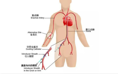 涨姿势：支架是如何放进心脏的？