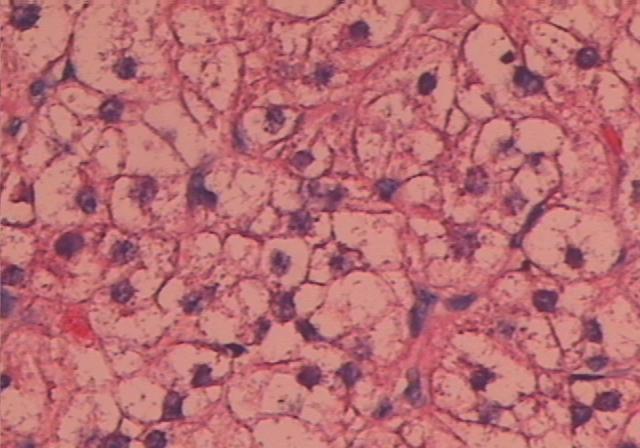 CT病例：卵巢非特异性类固醇瘤一例 