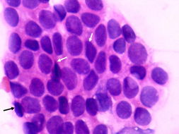 Br J Cancer：乳腺癌高危女性，是时候戒酒了