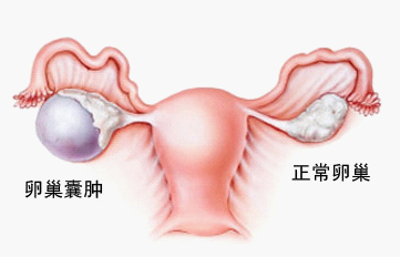 新的检测方法帮你远离卵巢癌