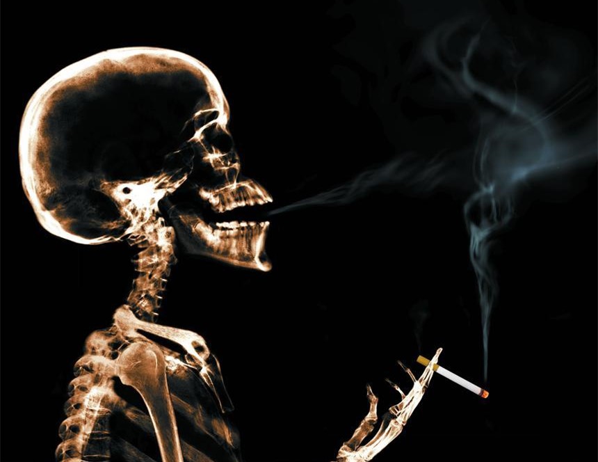 戒烟吧！蛛网膜下腔出血的罹患率与吸烟水平呈正相关！