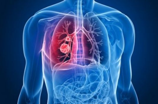 PLoS Comput Biol：抑制肺癌患者对药物产生耐受性的新策略