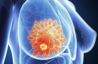 抗抑郁药的使用，降低女性乳腺癌患者存活率