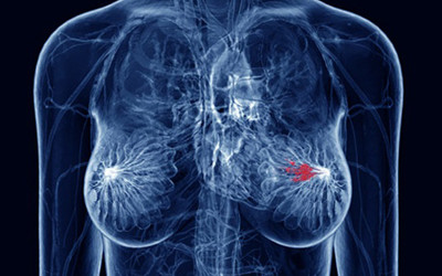 Oncogene：又一项“饿死”癌细胞疗法 杀死难治性乳腺癌