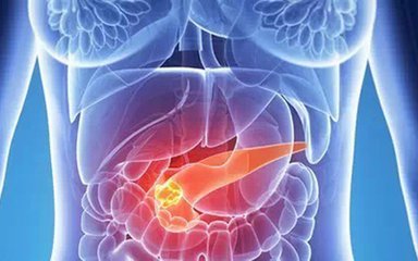 研究发现胰腺癌治疗新靶点