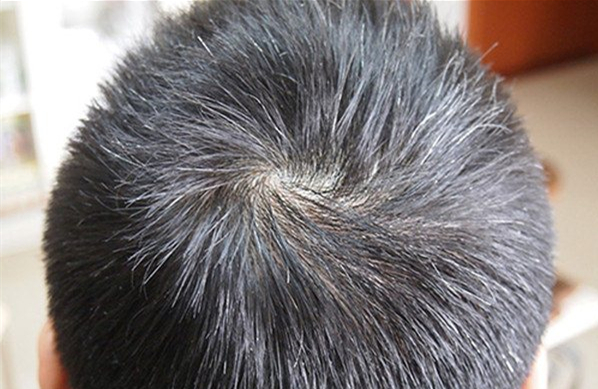 头发灰白是衰老？检查心脏或是重点！