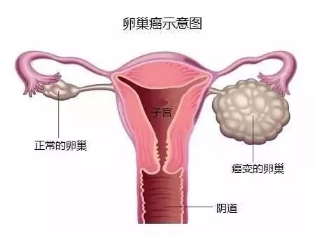 为避孕药正名！《JAMA》超15年、逾10万研究证明：避孕药可大大降低女性癌症发病率！