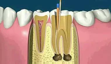 牙科患者的福音：干细胞或可使牙髓再生！