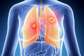 小细胞肺癌免疫治疗的研究进展