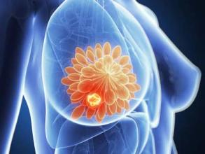 Cancer Cell：复旦大学绘制全球最大三阴性乳腺癌多组学精细图谱!