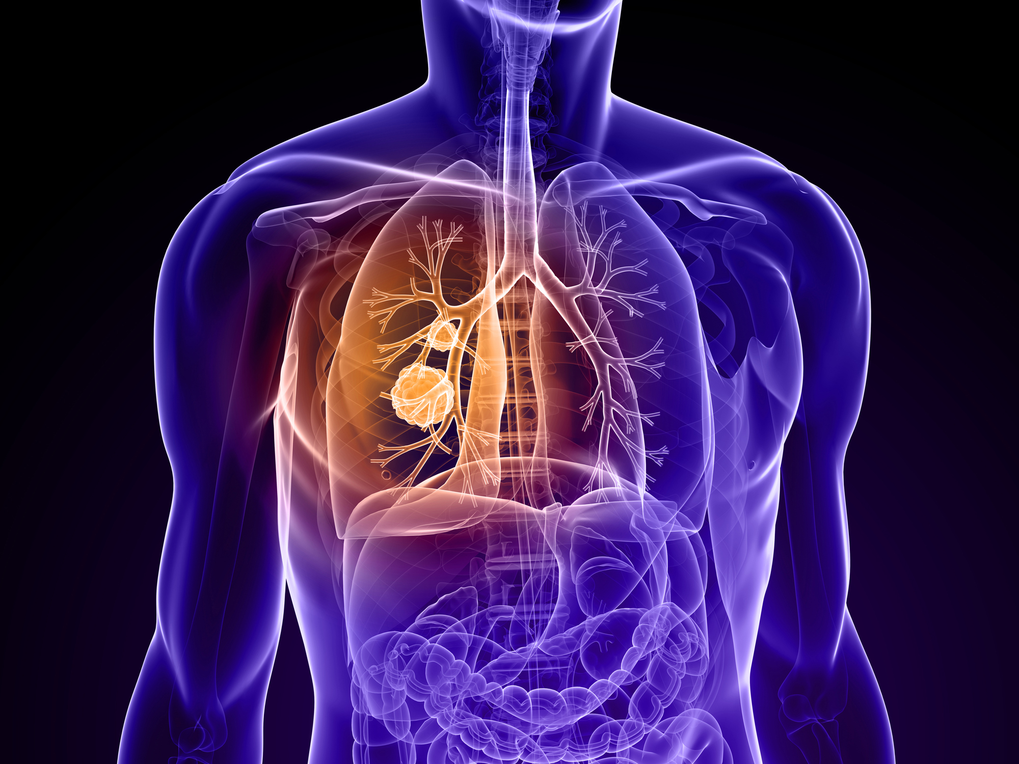 《Science》子刊：KRAS突变型肺癌或喜迎MEK抑制剂联合用药