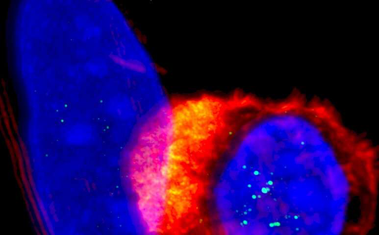 【Science子刊】以毒攻癌！蝎毒修饰的CAR-T免疫疗法精准对抗胶质母细胞瘤