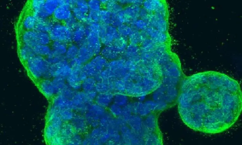 【新发现】晚期乳腺癌患者中找到一种神秘蛋白，有望治疗乳腺癌