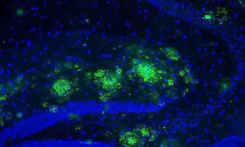 【新发现】伦敦大学最新研究：消极太恐怖！长期处于消极思维模式更易患老年痴呆