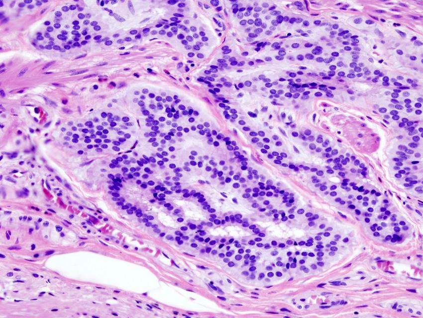 【Nature子刊】新发现：结直肠癌的发病与肠道微生物密不可分