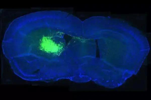 【Nature子刊】弗吉尼亚大学李辉团队：鉴定出胶质母细胞瘤的致癌基因，致命性脑瘤治疗有希望