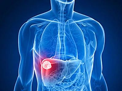 【BMJ】研究人员发现舒尼替尼和射频消融联合治疗肝癌，可降低肿瘤的生长并延长小鼠寿命！