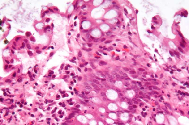 【新研究】炎症性肠病：科学家发现新方法可指示免疫细胞帮助修复肠道内受损组织