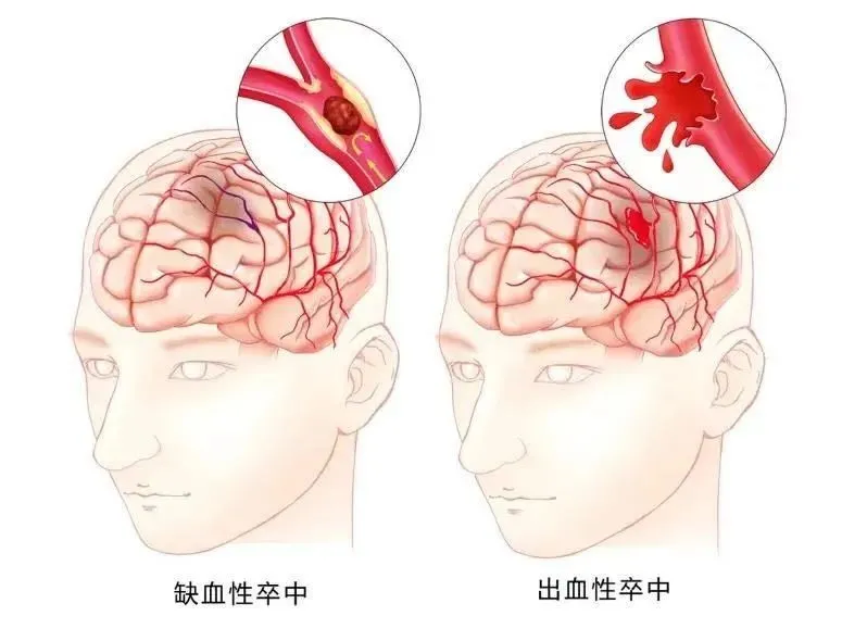 【Science子刊】细胞重组编程取得新突破|细胞疗法可帮助中风患者的修复大脑并有望恢复90%的运动功能